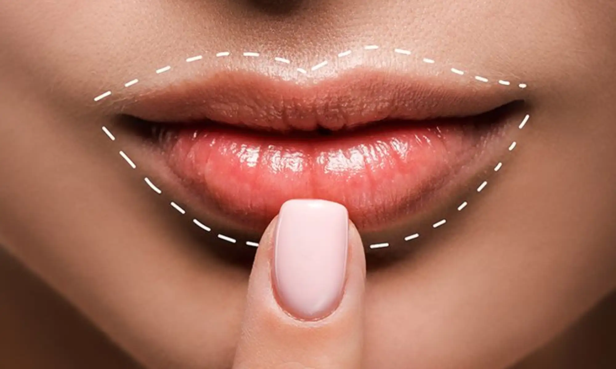Lip Plumping Treatment in Naperville, IL - Aesthetic Services