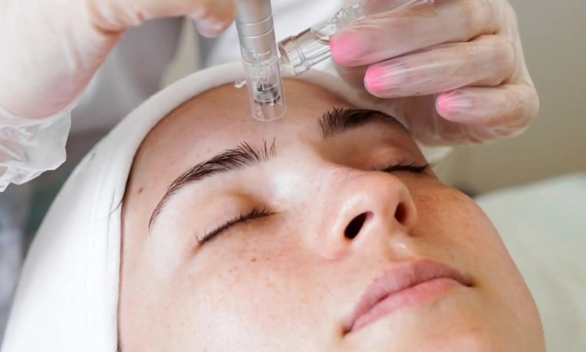 Microneedling Collagen Induction Therapy in Naperville, IL