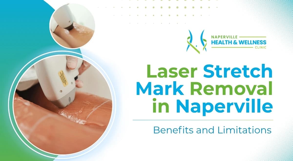 Laser stretch mark treatment in Naperville, with a handheld laser device treating stretch marks on the skin at Naperville Health & Wellness Clinic